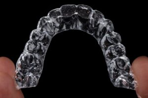 Aligners vs Braces