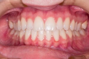 Gum Diseases