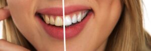 Teeth Whitening Techniques